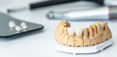 Dental Implants Image
